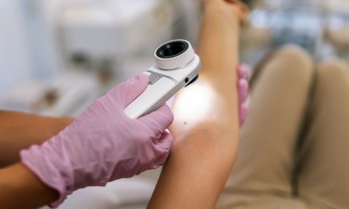 UV rays are responsible for over 80% of global melanoma cases, says WHO agency