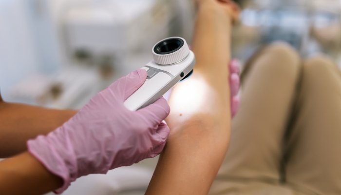 UV rays are responsible for over 80% of global melanoma cases, says WHO agency